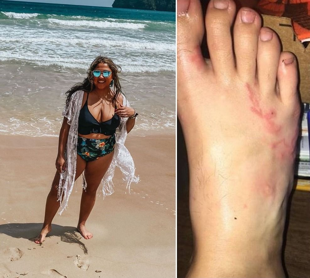 Woman standing barefoot on beach / Foot with hookworm crawling in it