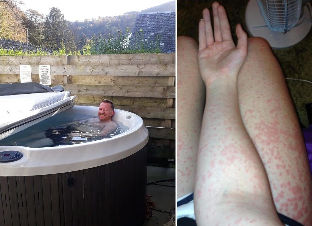 Man in hot tub / Woman with hot tub rash